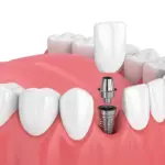 İmplant sonrası ağrı olur mu? Pain After Implant Surgery