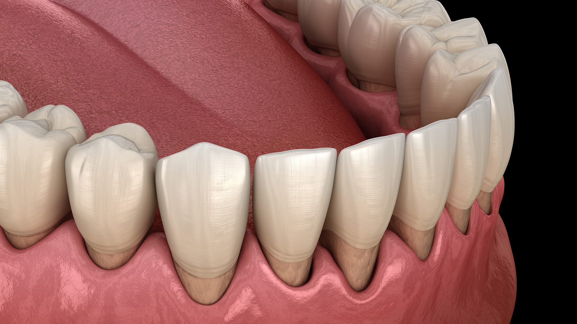 Antalya Diş Eti Çekilmesi Gum Recession Treatment in Turkey