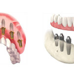 Antalya All On Six İmplant Tedavisi All On Six Implant Treatment in Turkey