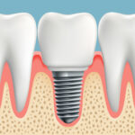Antalya Diş İmplantı Dental Implant Candidacy Turkey